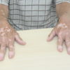 Pessoa com as mãos com vitiligo em cima de mesa