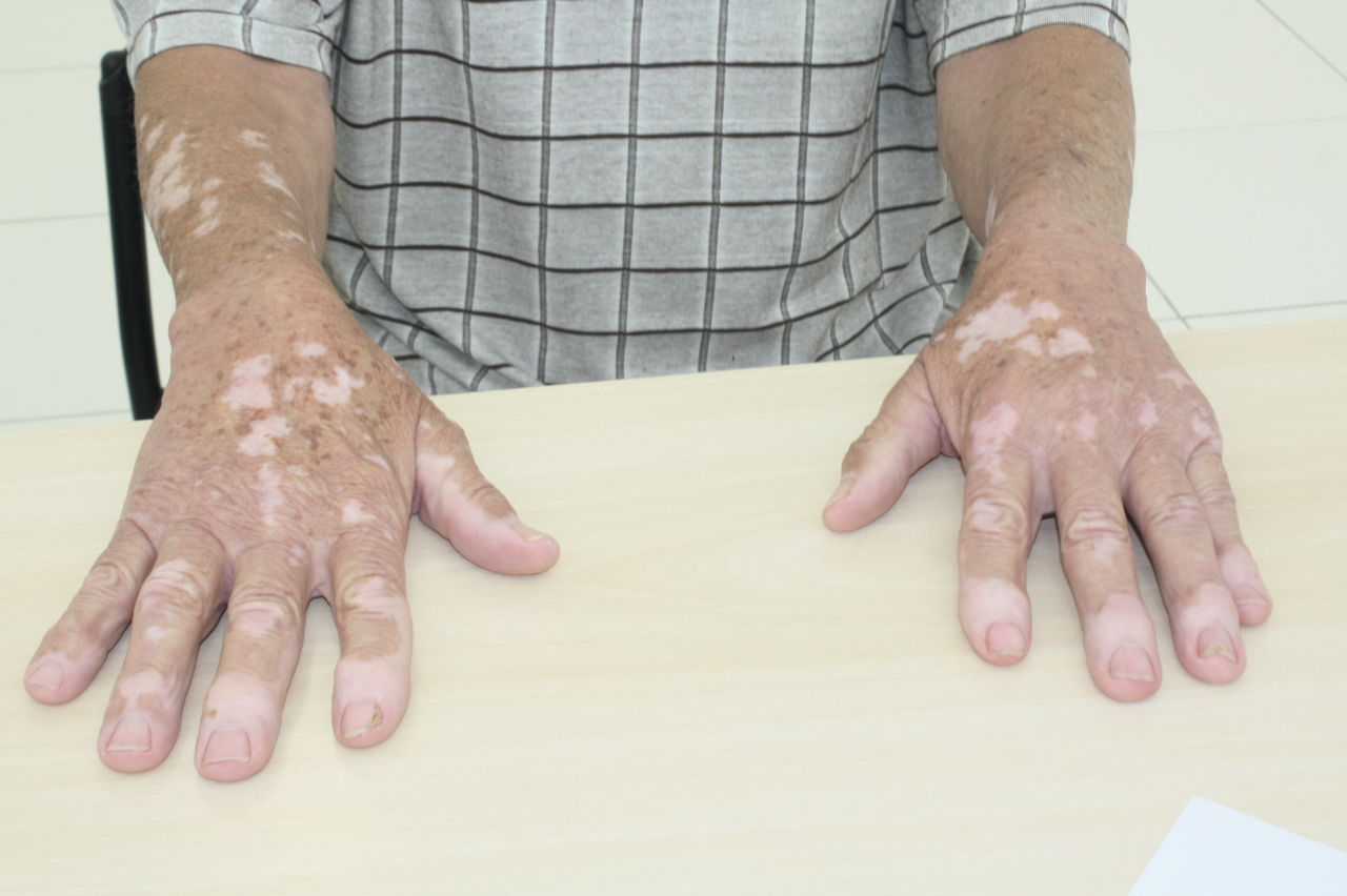 Pessoa com as mãos com vitiligo em cima de mesa